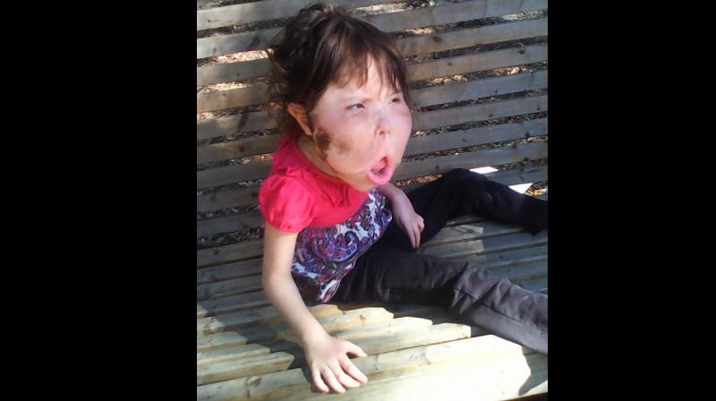 Girl with over-sized brain has condition so rare, doctors might name it after her