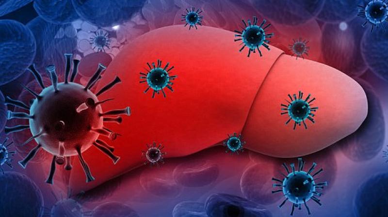 While acute hepatitis may be triggered by some infection, certain drugs, alcohol or other immune related factors, chronic condition can be due to hepatitis virus- A/B/C/D&E.