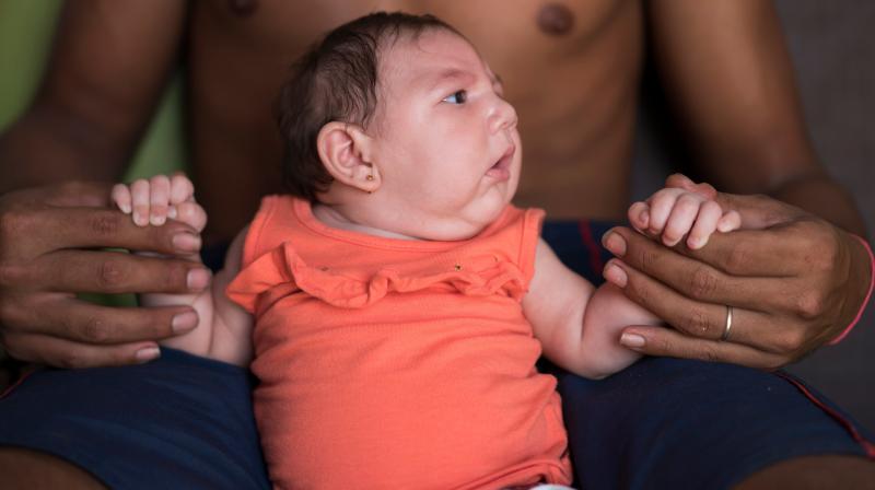 Microcephaly often signifies arrested brain development. (Photo: AP)