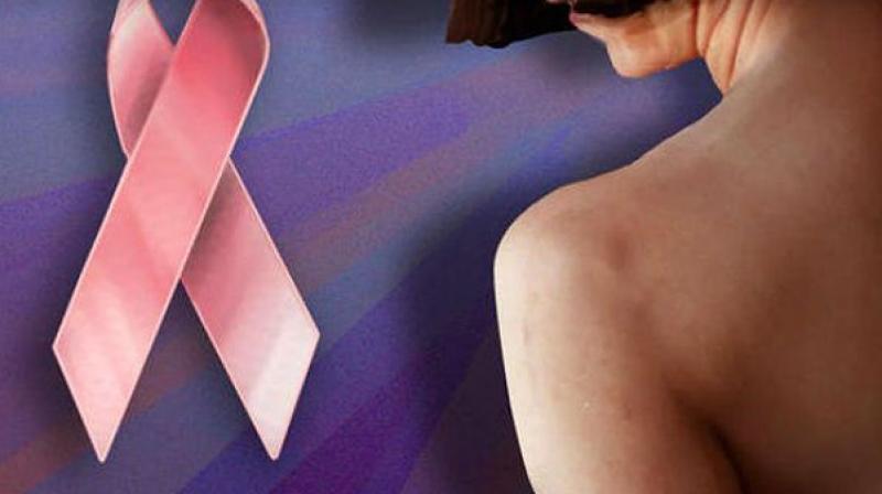 Breast cancer is maong the most common cancer found in women. (Representational Image)