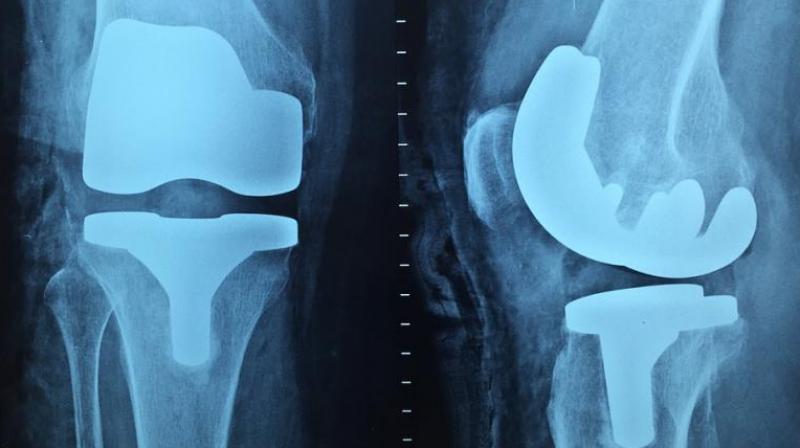 The findings suggest that the selective removal of old cells from joints could reduce the development of post-traumatic OA. (Photo: Pixabay)