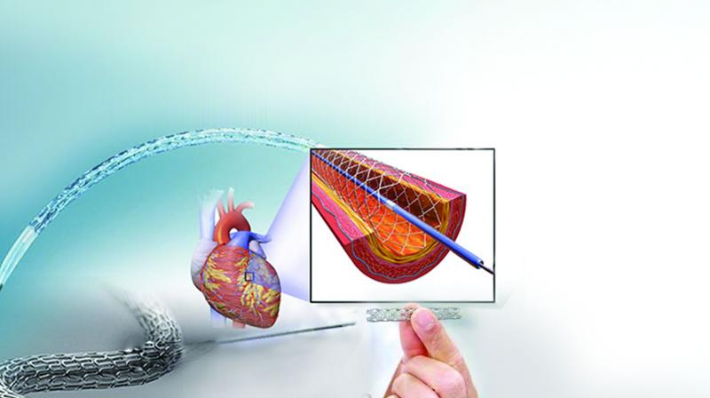 Rs 27,890 Present price of each stent in India.