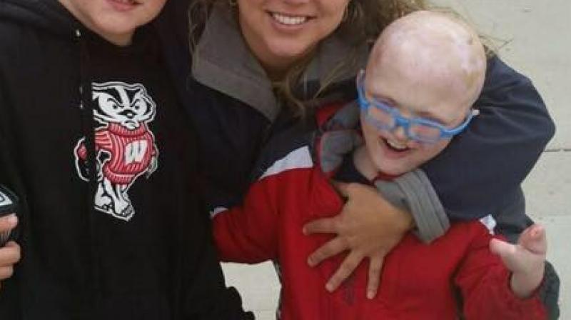 Ethan Kranig has condition called ectodermal dysplasia-cleft syndrome (EEC). (Photo: Facebook / Natalie Kranig)