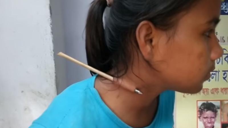 The arrow missed her windpipe and blood vessels (Photo: YouTube)