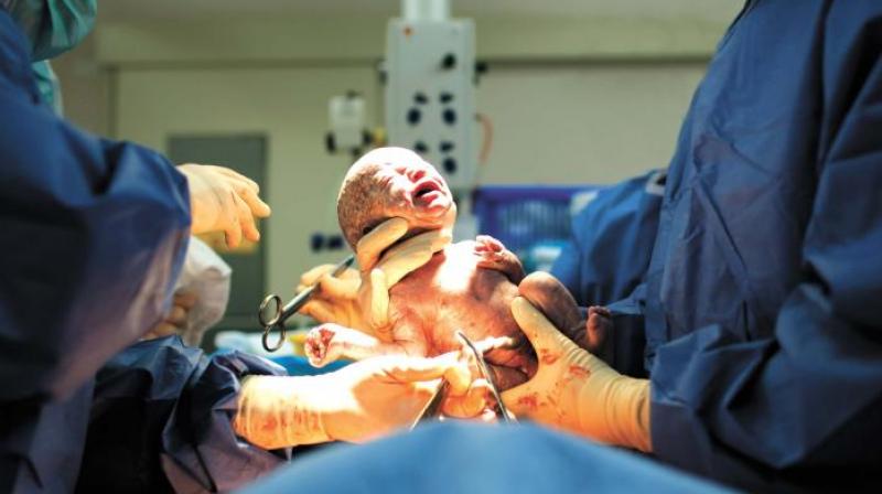 According to popular perception, it is thought that many private hospitals carry out C-section deliveries as money involved in birth by intervention is more.  ( Representational image)