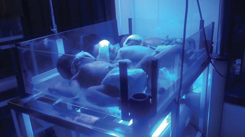 Three children are seen placed together in one phototherapy machine at the unit in the hospital.