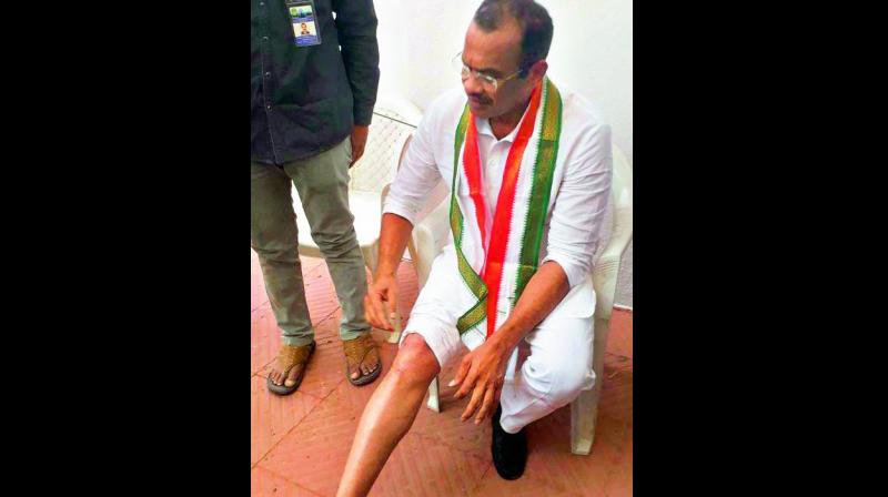 Komatreddy Venkat Reddy show the injuries he sustained in the Assembly when the Budget Session commenced.