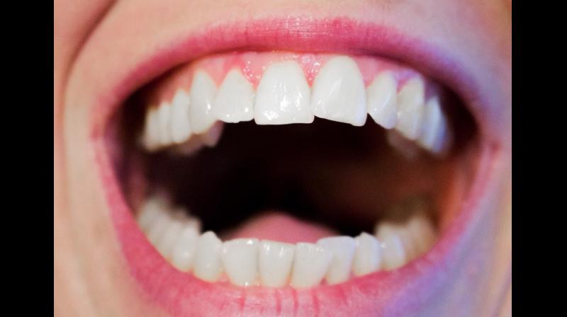 The bacteria, Porphyromonas gingivalis, known as Pg, causes the gum infection chronic periodontitis. (Photo: Pixabay)