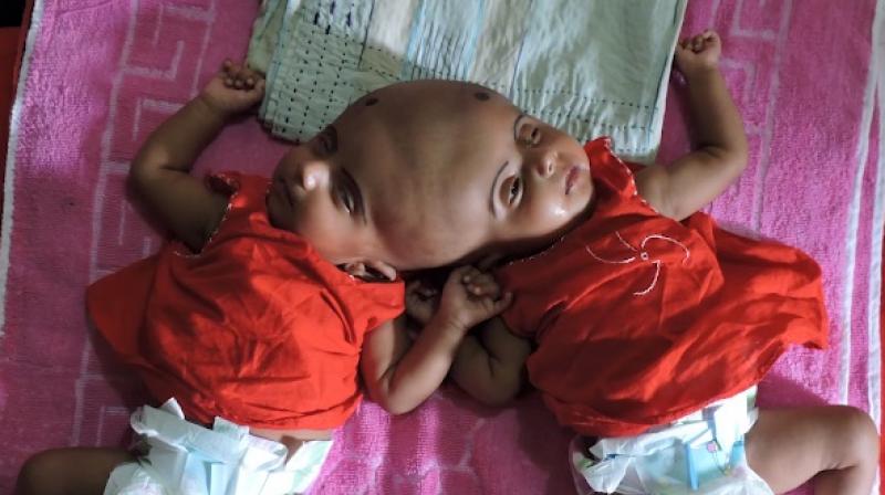 Conjoined twins facing early death to undergo surgery to seperate their ...