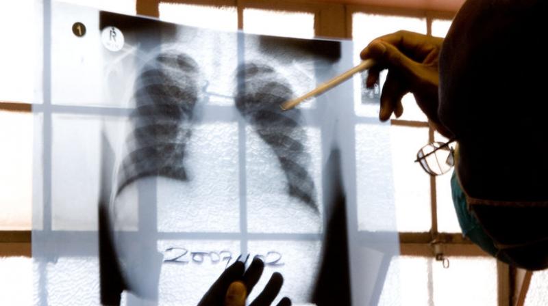 Tuberculosis tricks the immune system into damaging our own lung tissue, which therefore makes the person highly infectious through coughing. (Photo: AP)