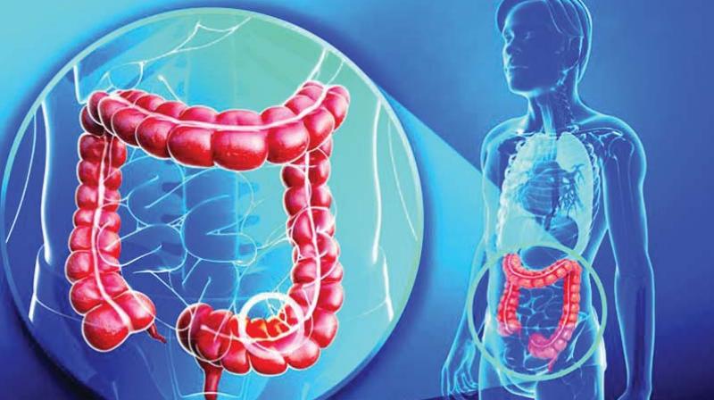 Rectal and colon cancers, depending on the origin, share common traits and are grouped together and collectively known as colorectal cancer.