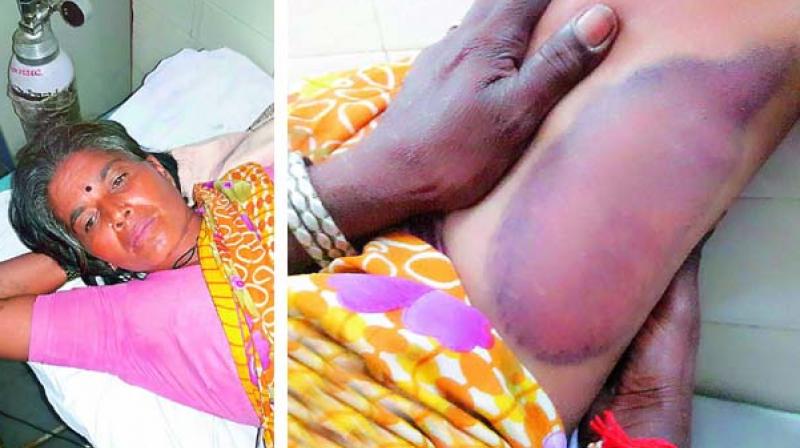 Kurma Balamani in hospital. The injuries on her leg.