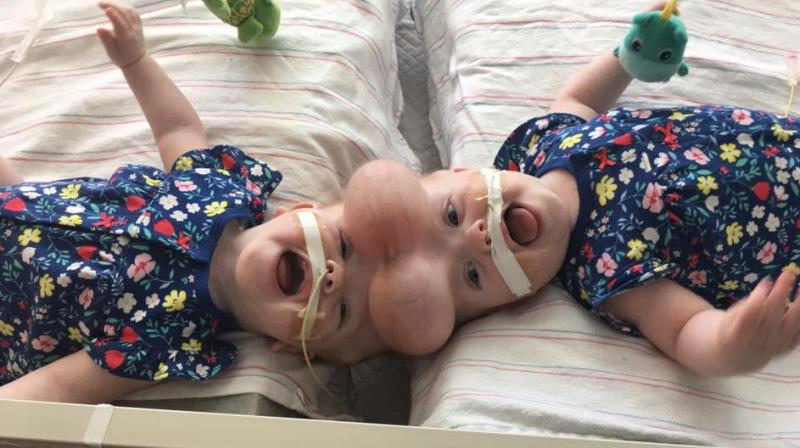 The twins underwent an operation at the Childrens Hospital of Philadelphia before which they were implanted with balloons at the head to expand the skin to have an easy operation. (Photo: Facebook/ConjoinedDelaneyTwins)