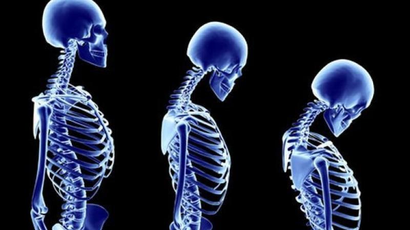 When human bones break down at a quicker pace than what they can be re-formed, bone thinning may occur. (Representational Image)