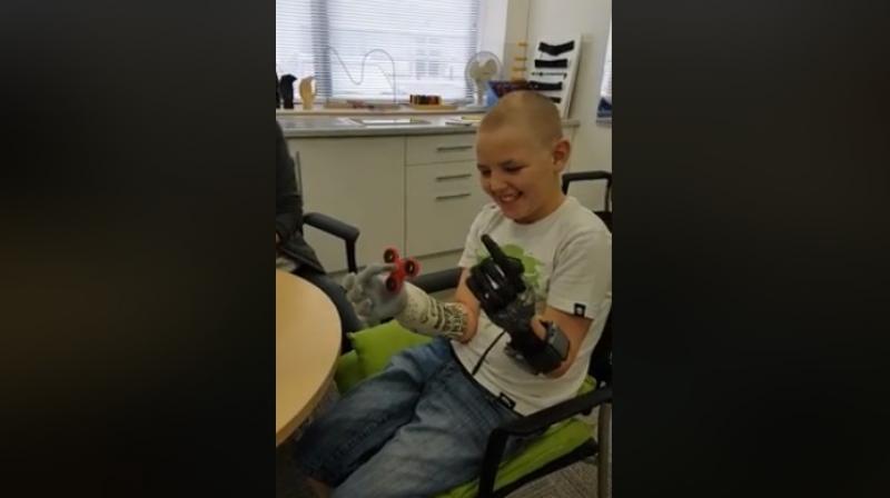 Alan needed to have both his hands amputated at the age of three after complications arising from a heart condition (Photo: Facebook screengrab/ Touch Bionics Centre of Excellence)