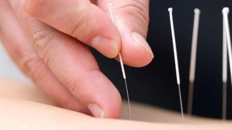 Acupuncture is a key component of traditional Chinese medicine. (Photo: Pixabay)