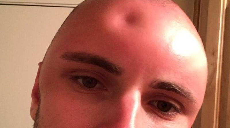 He shaved his head and went outdoors, it got severely sunburned and became swollen. (Photo: Twitter/CadeHuckabay)