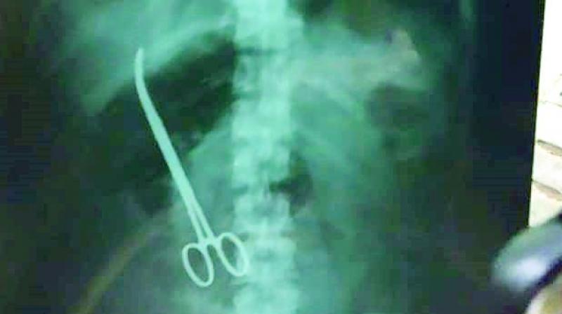 Hyderabad: Doctors forget forceps in womans abdomen