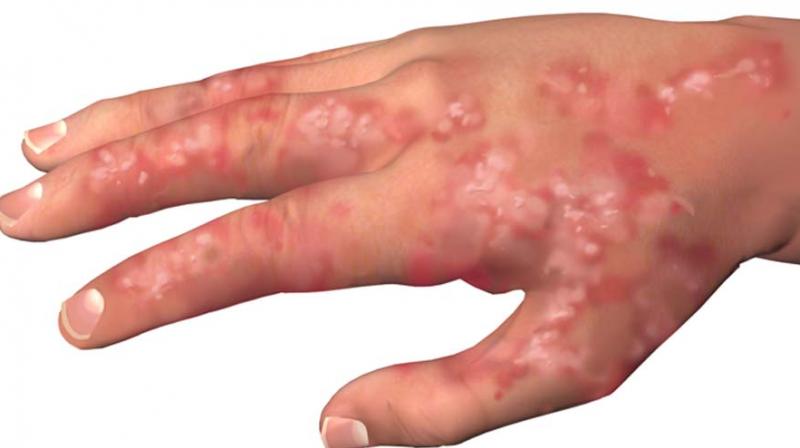 Patients suffering from skin infections and ailments used to be around 200 usually, but the number has now increased to 300 (Representational Image)