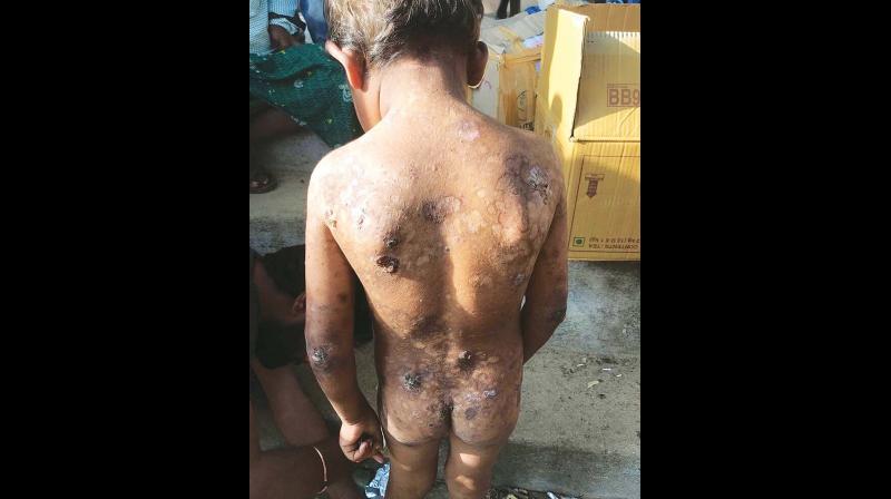 One of the children affected by skin disease caused due to excess of arsenic and fluoride in water.