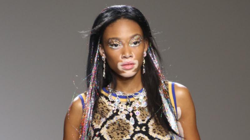 Well-known model Chantelle Brown-Young has vitiligo. (Photo: AP)