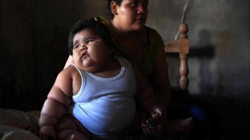 Obesity in childhood increases osteoarthritis risk. (Photo: AFP)