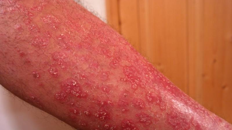 Rashes on body could indicate cancer, says study