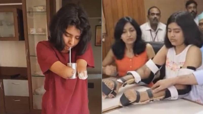 The family of a boy who had died in a motorbike crash donated the arms (Photo: YouTube)