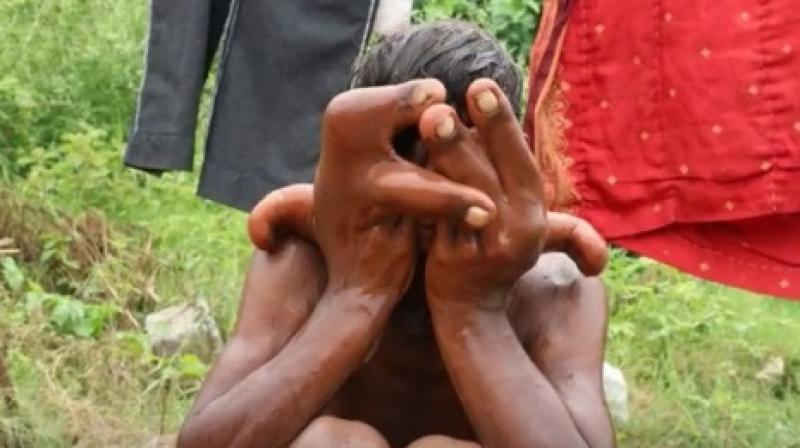Mysterious disease causes 12-year-old Indian boys hands to grow 2 inches long (Photo: Youtube)