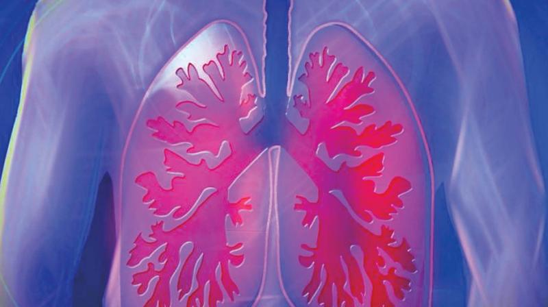 Smoking remains the most common cause of COPD that shows various symptoms such as breathlessness, cough and wheezing.